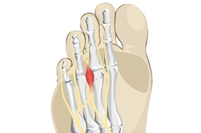 Complications of Morton&rsquo;s Neuroma